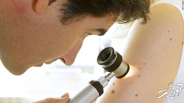 خال روی بازو